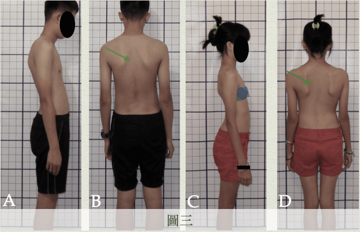 胸腔後倒伴隨駝背(圖AB)、胸腔後倒伴隨胸椎向前凹陷(圖CD)