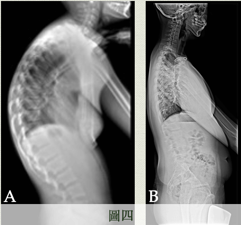 脊椎內部的曲線相互代償，胸椎後彎愈大(A)，頸椎或腰椎的前彎也愈多、當出現胸椎後彎不足時(B)，頸椎及腰椎的前彎也愈少