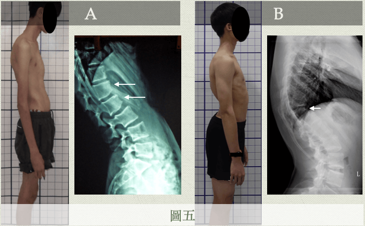 姿勢會受到骨頭結構變形所影響，青春期時骨頭前後生長速度不一致(A)、或是在母體胚胎內骨頭發育異常(B)