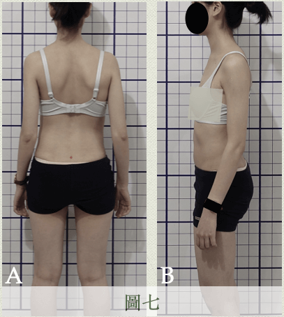 錯誤的駝背矯正方式2-內夾肩胛骨、收腹、夾臀