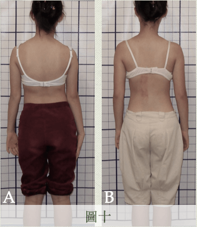 肩胛骨外開的駝背矯正方式