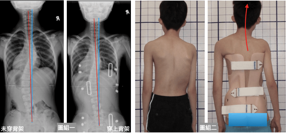 不穿脊椎側彎背架的理由~穿上背架使人體中心點偏離重力中心線