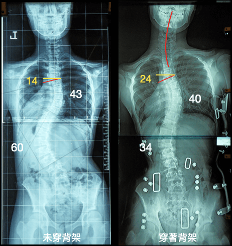 脊椎側彎背架造成一個彎度變好另一個變差