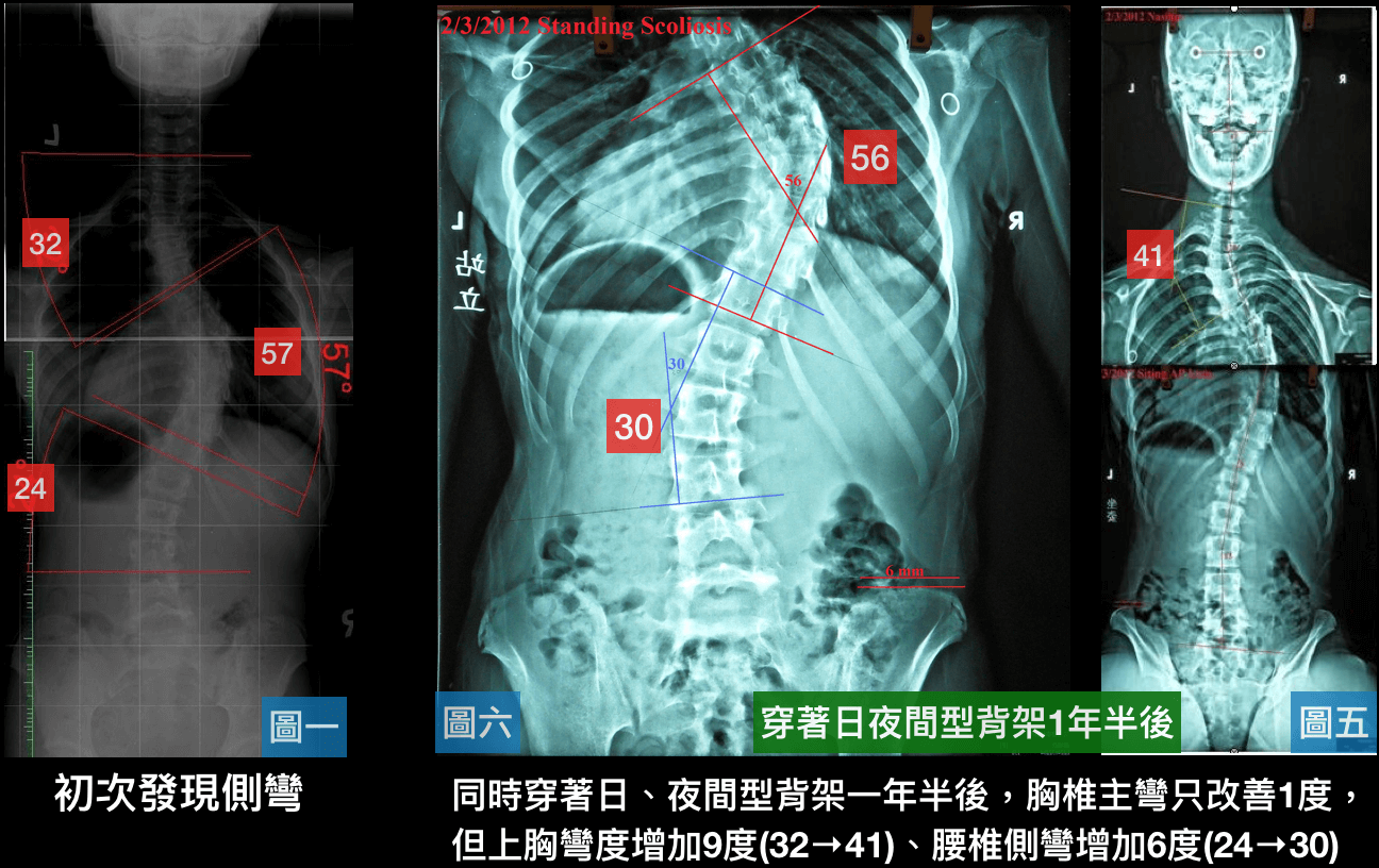 穿著不當背架~增加胸頸側彎