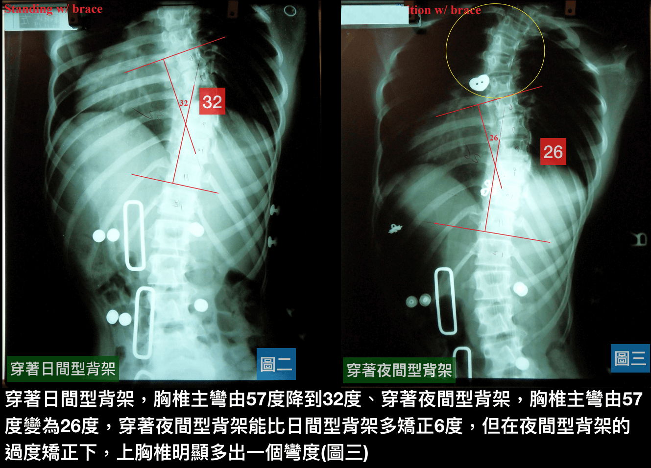 夜間型背架過度矯正~使胸頸側彎惡化