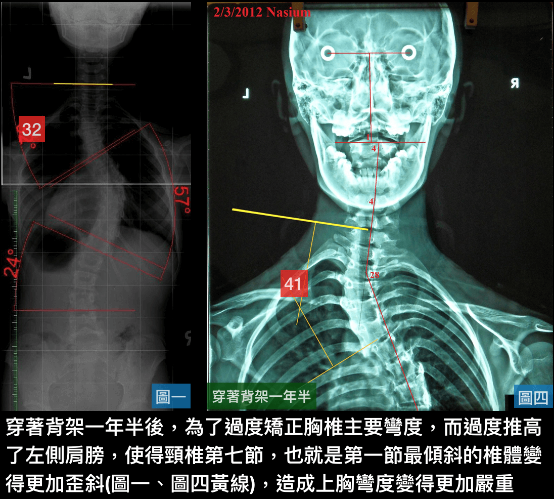 穿著不當背架~創造出新的彎度