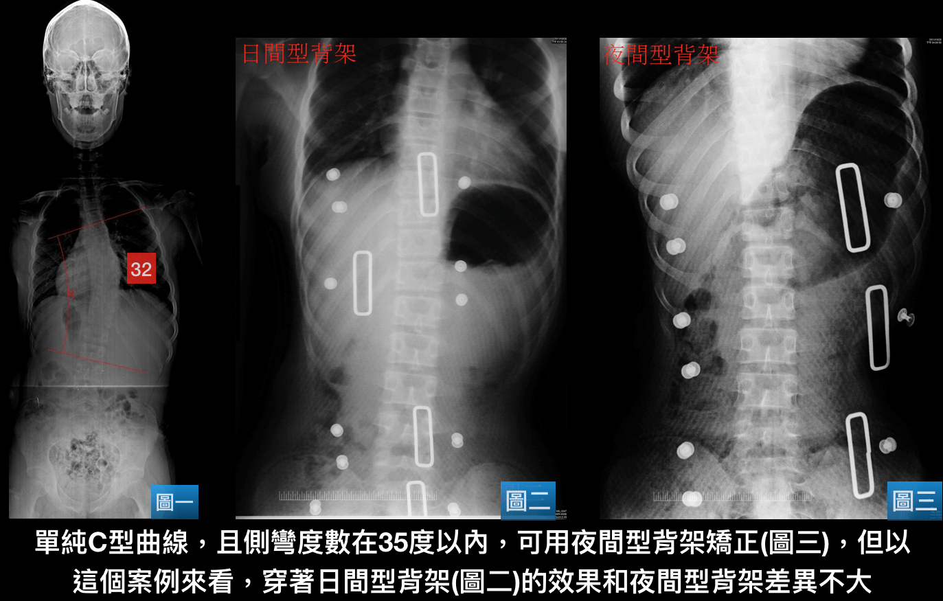 比較日夜間型背架成效