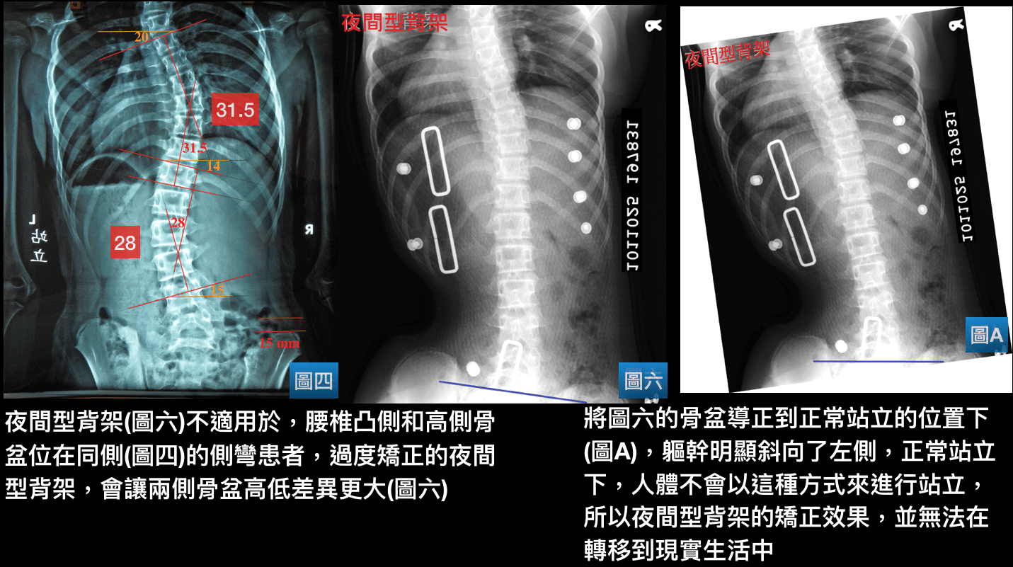 不適合夜間型背架案例-穿上夜間型背架後使骨盆更加歪斜