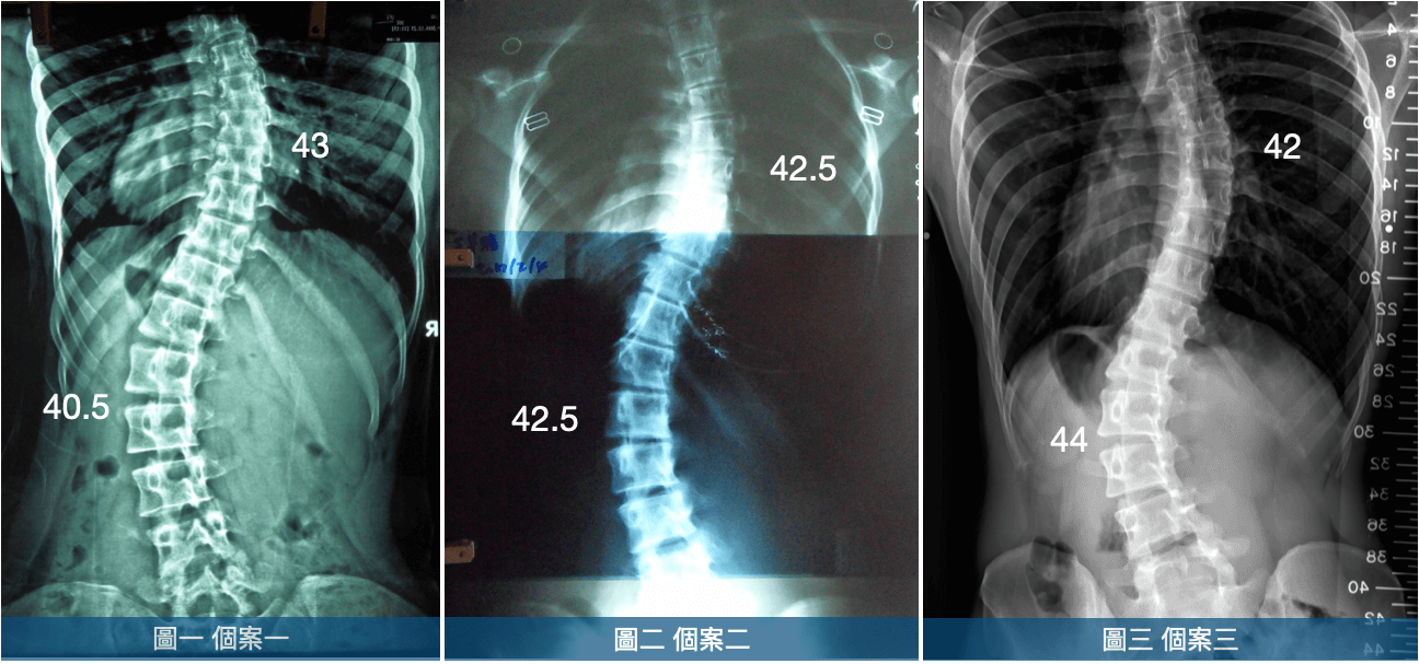 胸椎、腰椎S型雙主彎