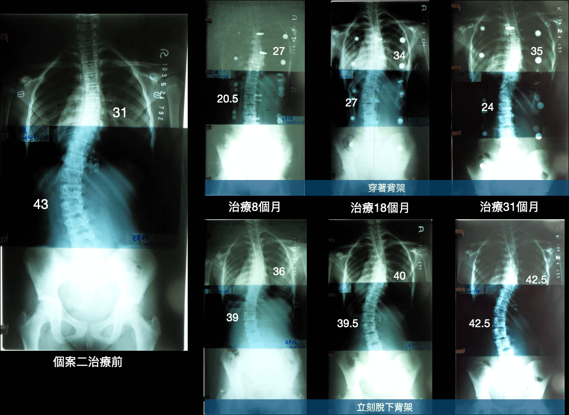 穿著背架治療前後比較