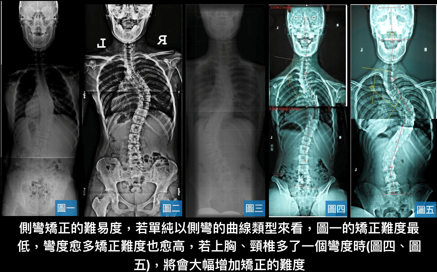 側彎曲線類型對側彎矯正的難易度