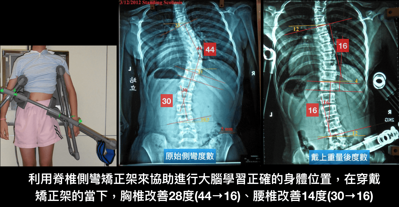 脊椎側彎運動~重量系統