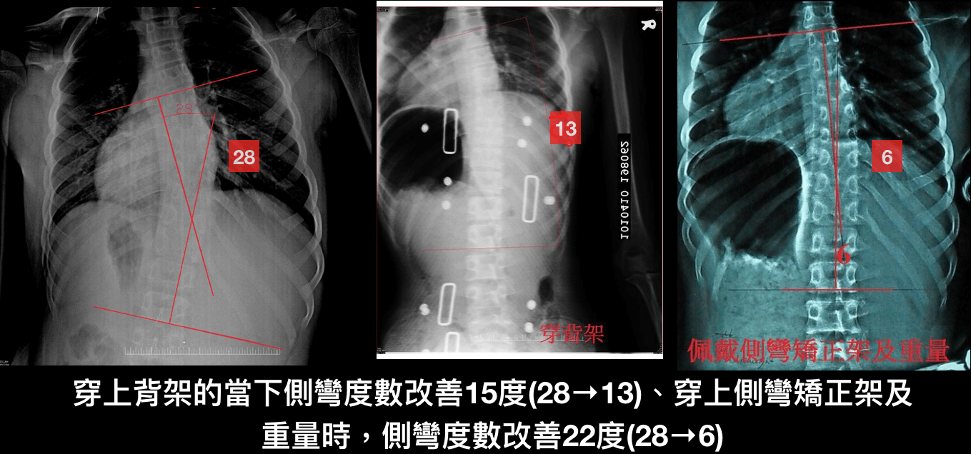 脊椎側彎運動~重量系統案例1