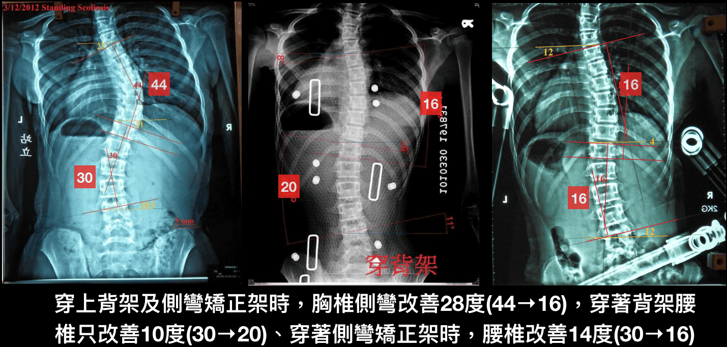 脊椎側彎運動~重量系統訓練案例2