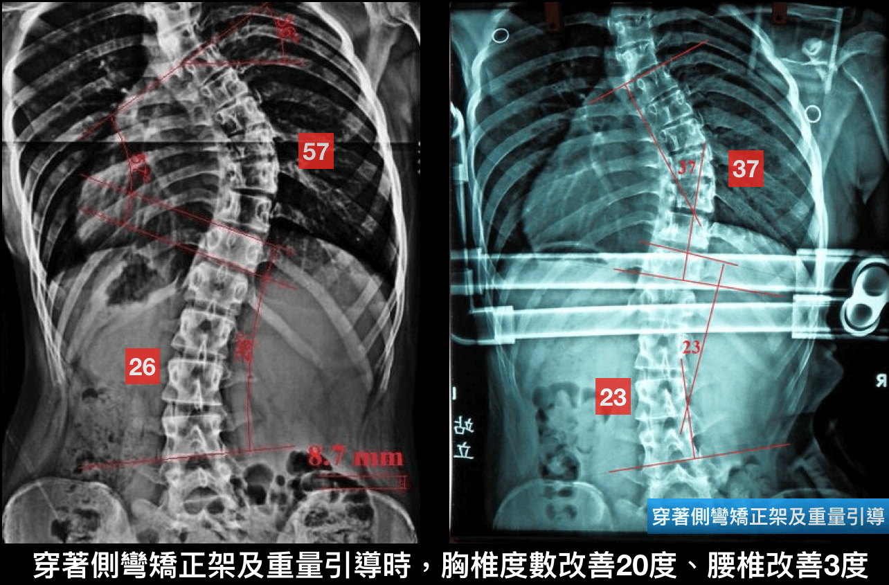 脊椎側彎運動~重量系統訓練案例3