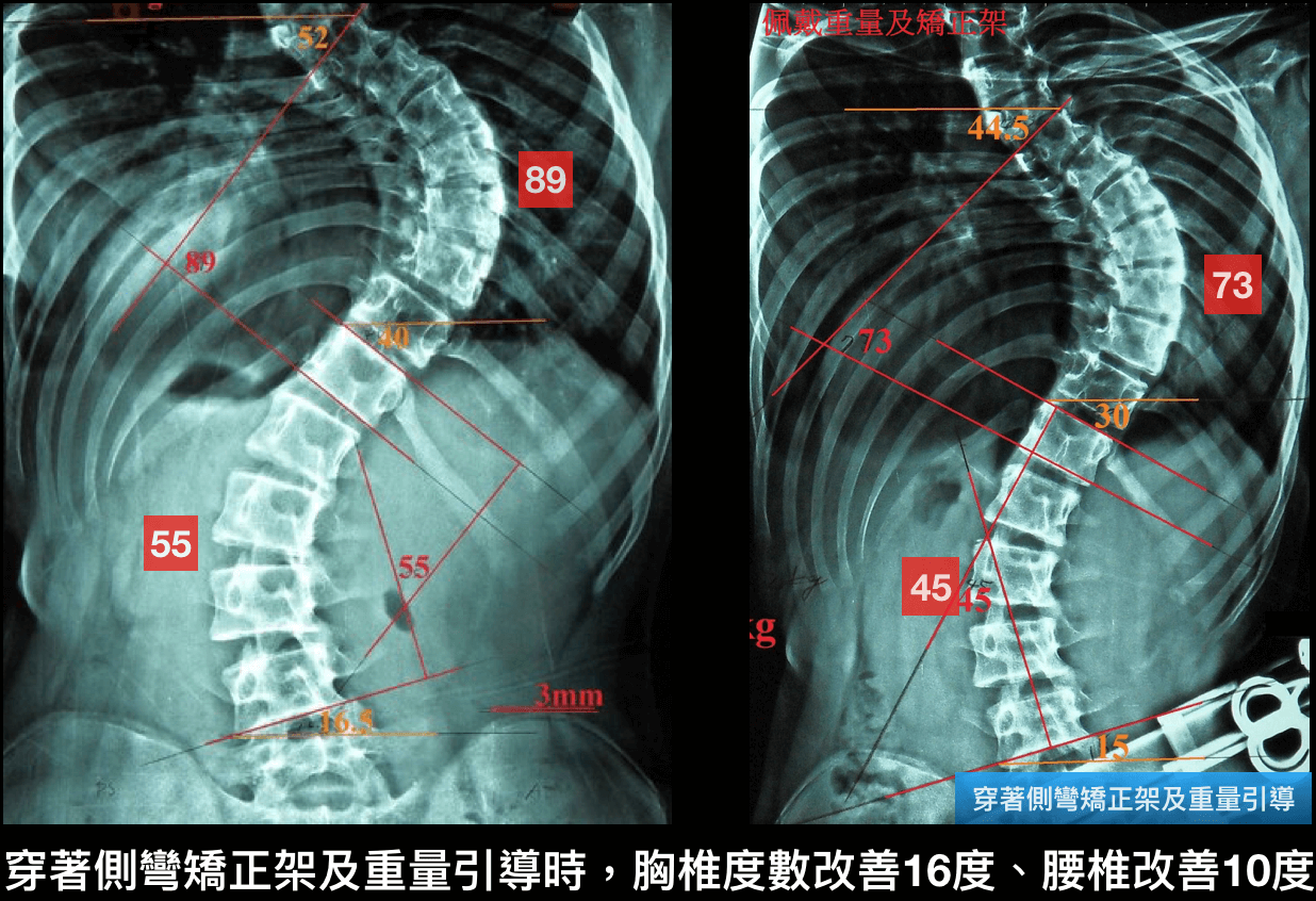 脊椎側彎運動~重量系統訓練案例4