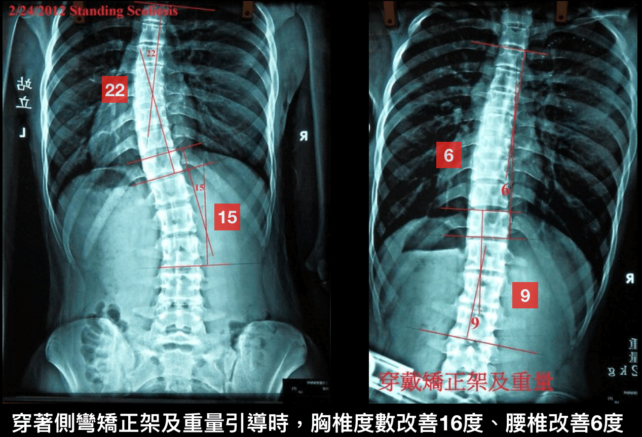 脊椎側彎運動~重量系統訓練案例5