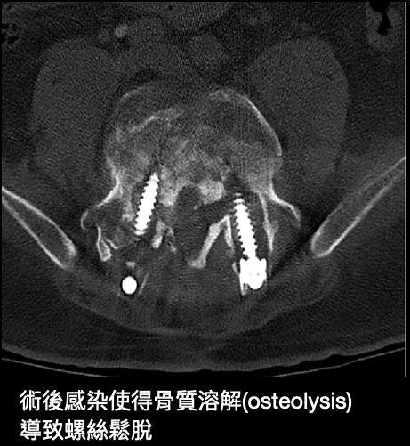 脊椎內固定鬆動