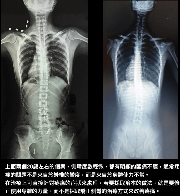 輕度脊椎側彎，疼痛通常和身體的用力習慣有關