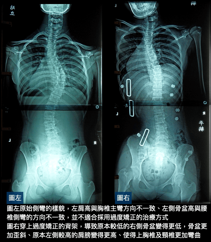 利用背架採用過度矯正治療，創造更難解決的彎度