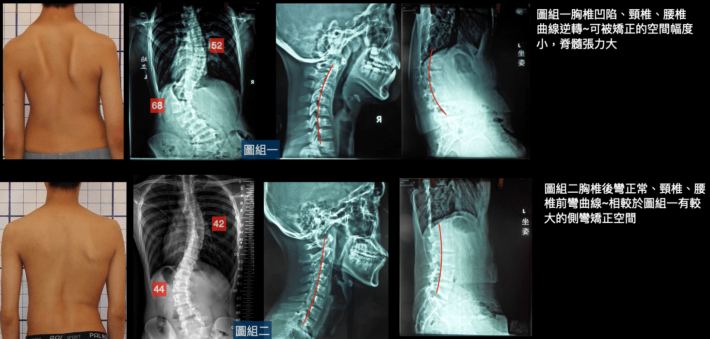 脊椎側彎伴隨正常及異常頸椎、胸椎及腰椎側面曲線