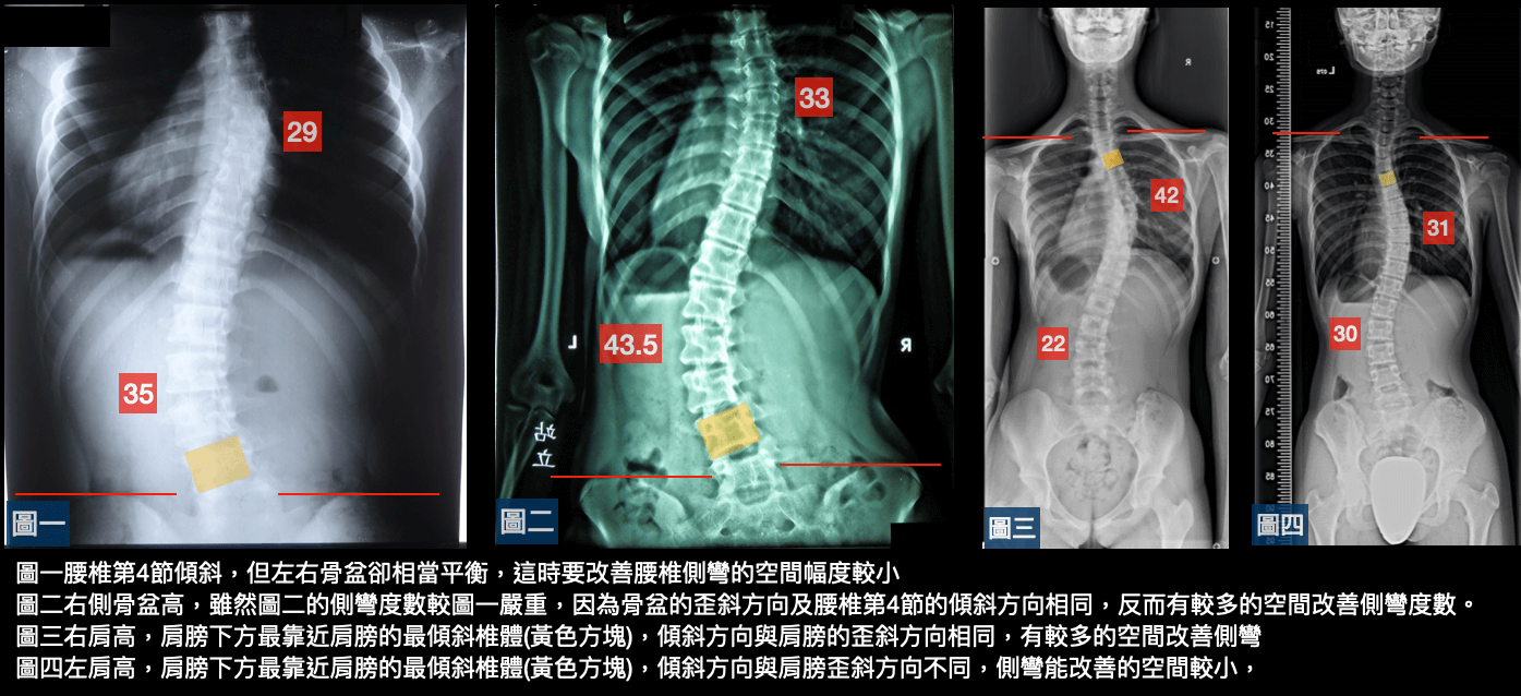 判斷是否有足夠空間進行側彎矯正治療