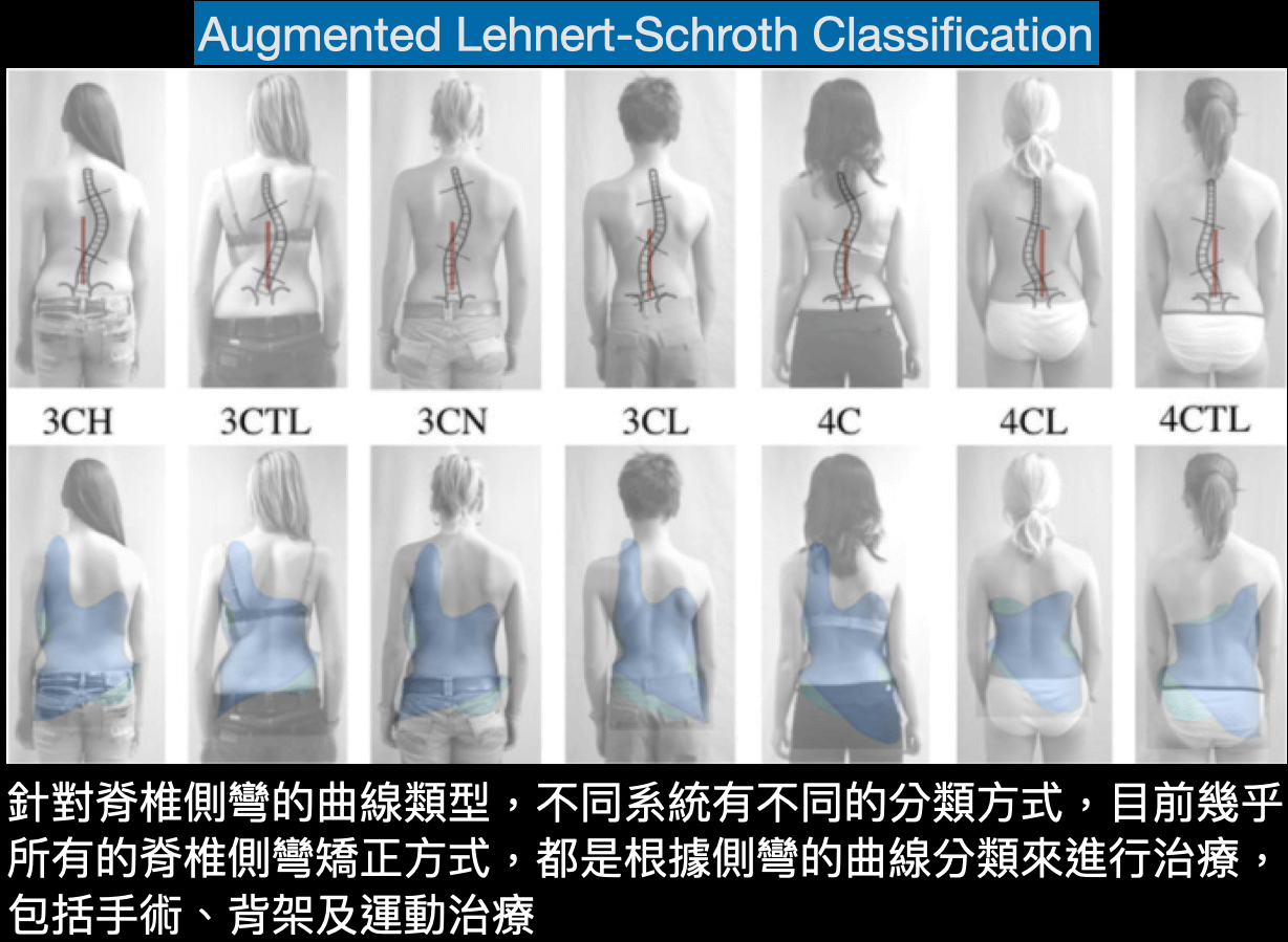 擴充版Schroth(許瑞氏/施羅特)側彎曲線類型分類方式