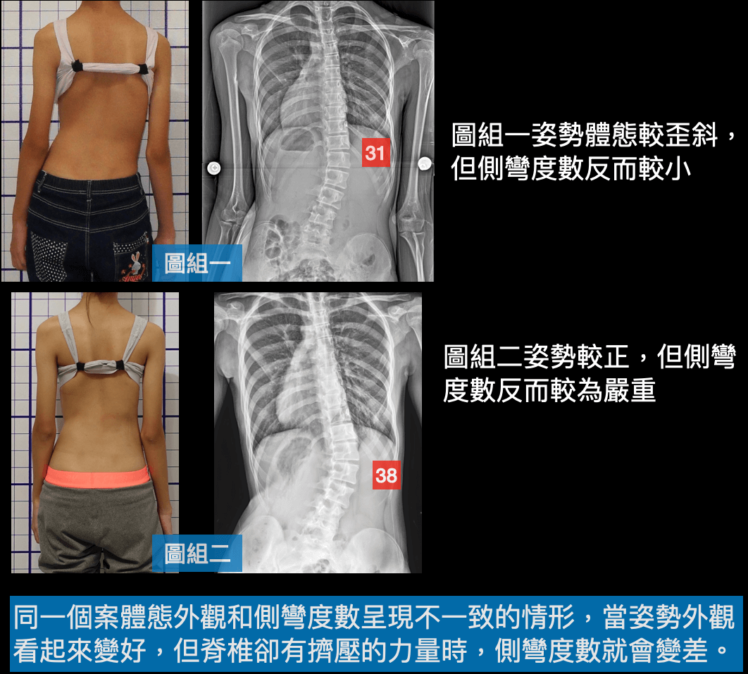 姿勢外觀看似變好，側彎度數也可能變差