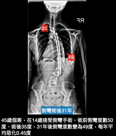 側彎度數在術後31年後回到原本狀態，疼痛隨著年齡增長不斷增加