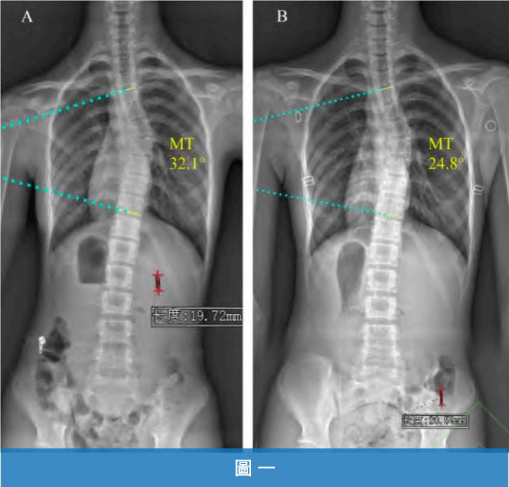 大腦學習訓練法-50位脊椎側彎矯正案例臨床研究-cobb angle改善
