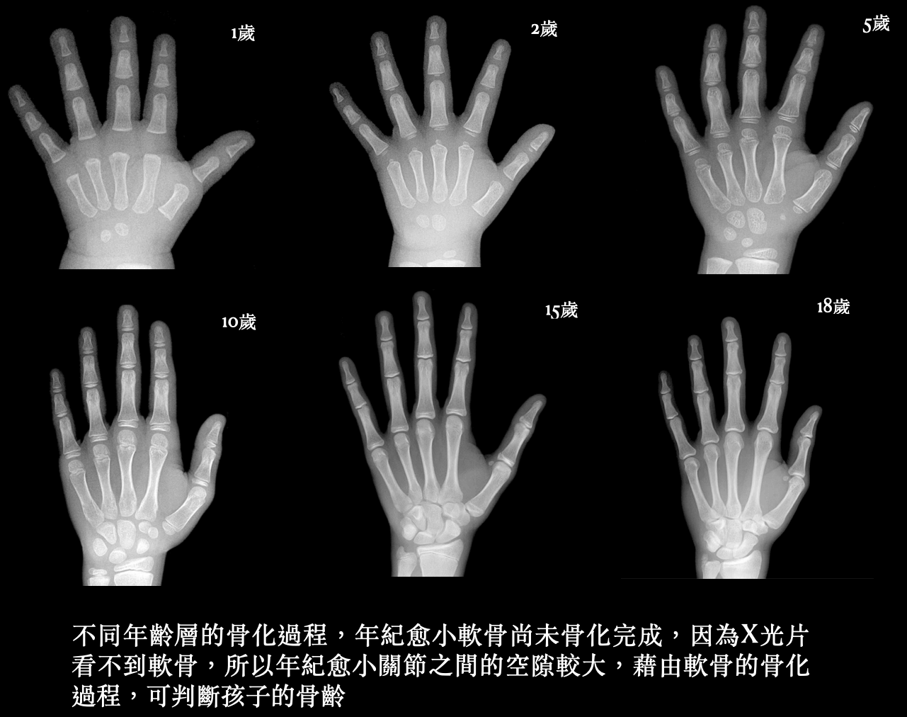 成長中的側彎孩子，透過X光片檢視骨頭上下兩端或邊緣處的變化，可推論骨頭的發育年齡