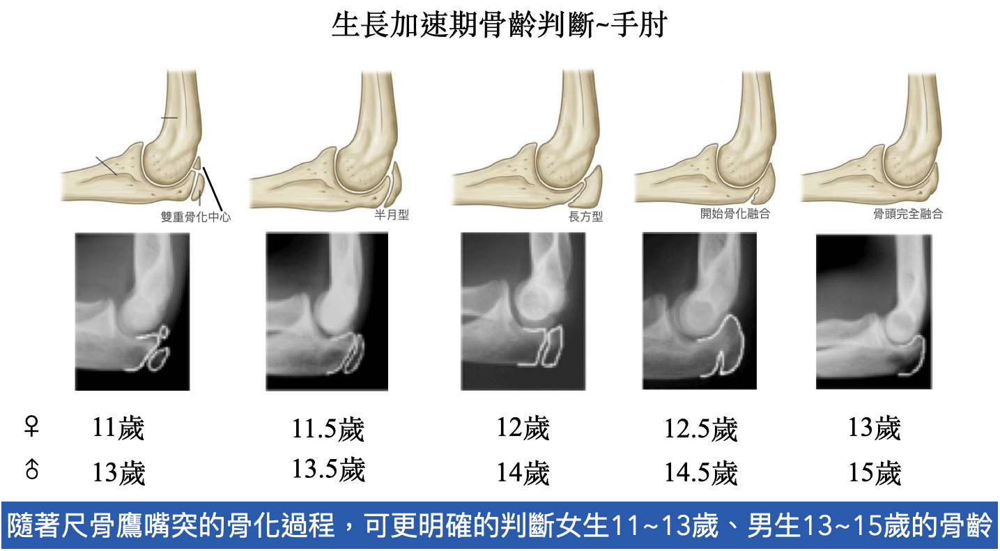檢視手肘鷹嘴突的骨化情況來判斷側彎孩子生長加速期的骨齡