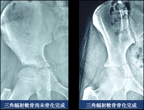 檢視骨盆的三角幅射軟骨來判斷側彎孩子生長加速期的骨齡