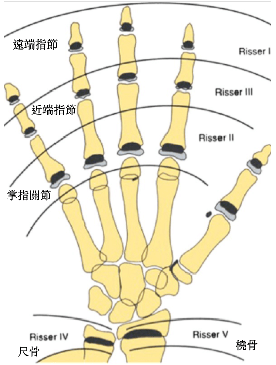 檢視手掌及手腕骨化情況，可同時判斷側彎孩子生長加速期及生長減速期的骨齡