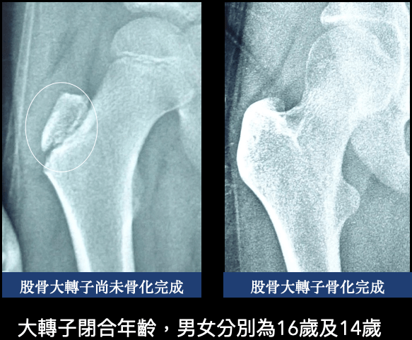 檢視股骨(大腿骨)大轉子的骨化程度來判斷側彎孩子生長減速期的骨齡