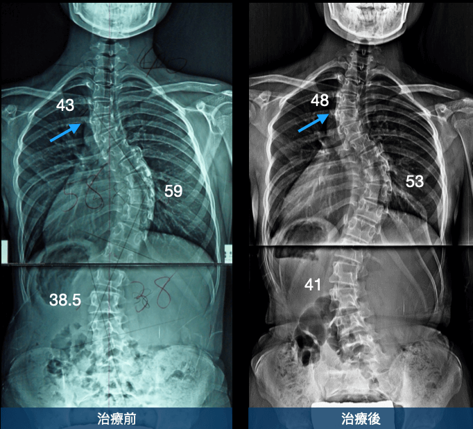 上胸椎出現側彎，矯正難度愈高