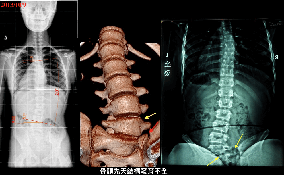 失天性脊椎側彎-薦椎發育不全