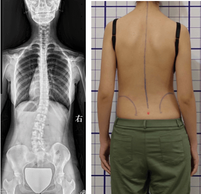 非典型脊椎側彎-側彎與旋轉方向不一致