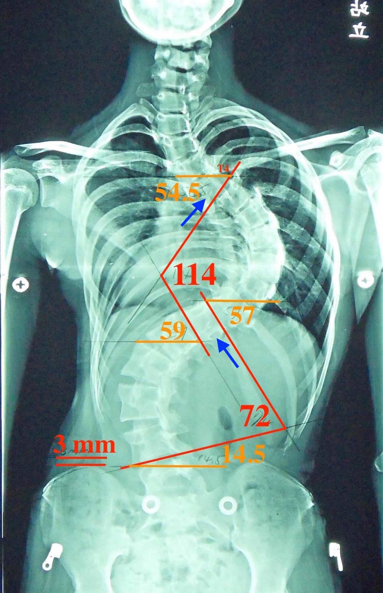 胸椎側彎度數超過100度