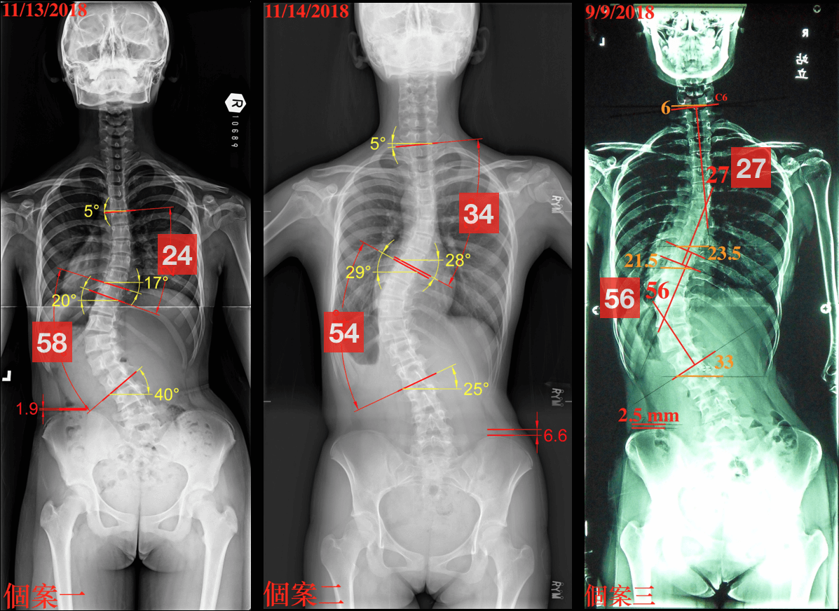胸腰側彎X光案例比較