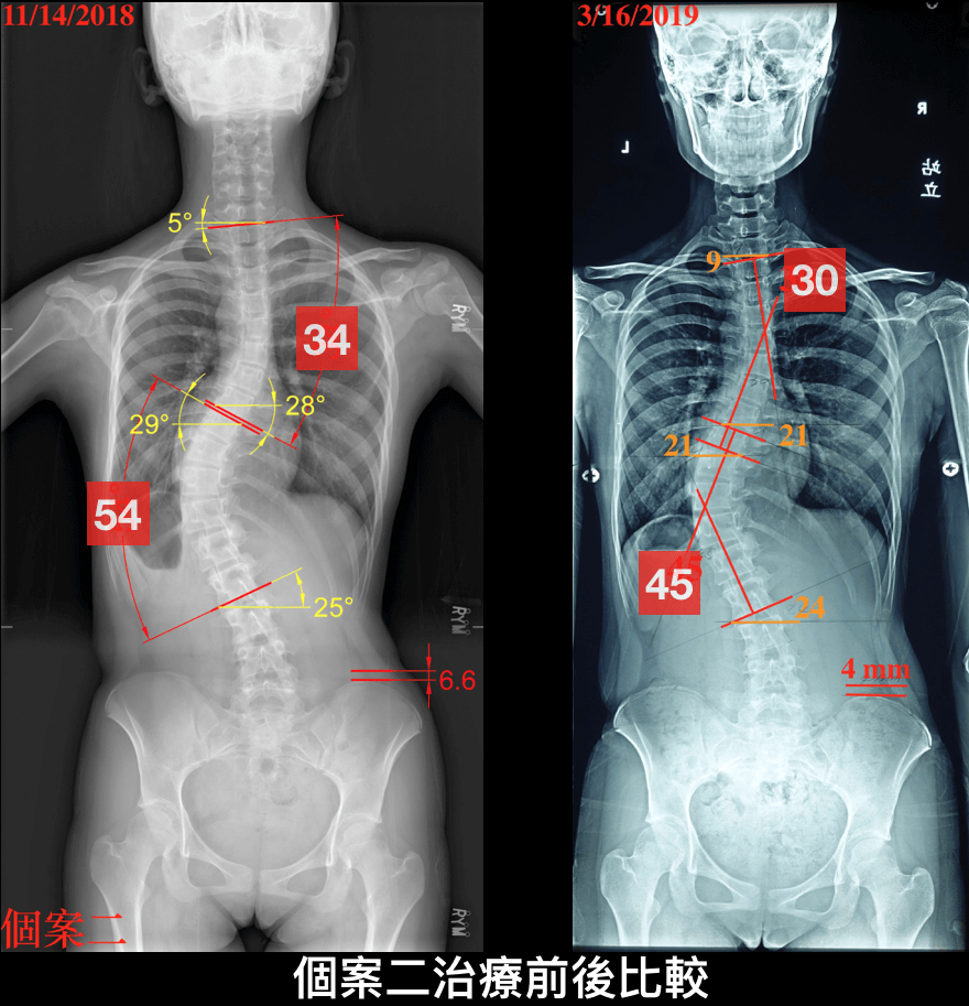 不穿脊椎側彎背架，成功改善胸腰側彎案例