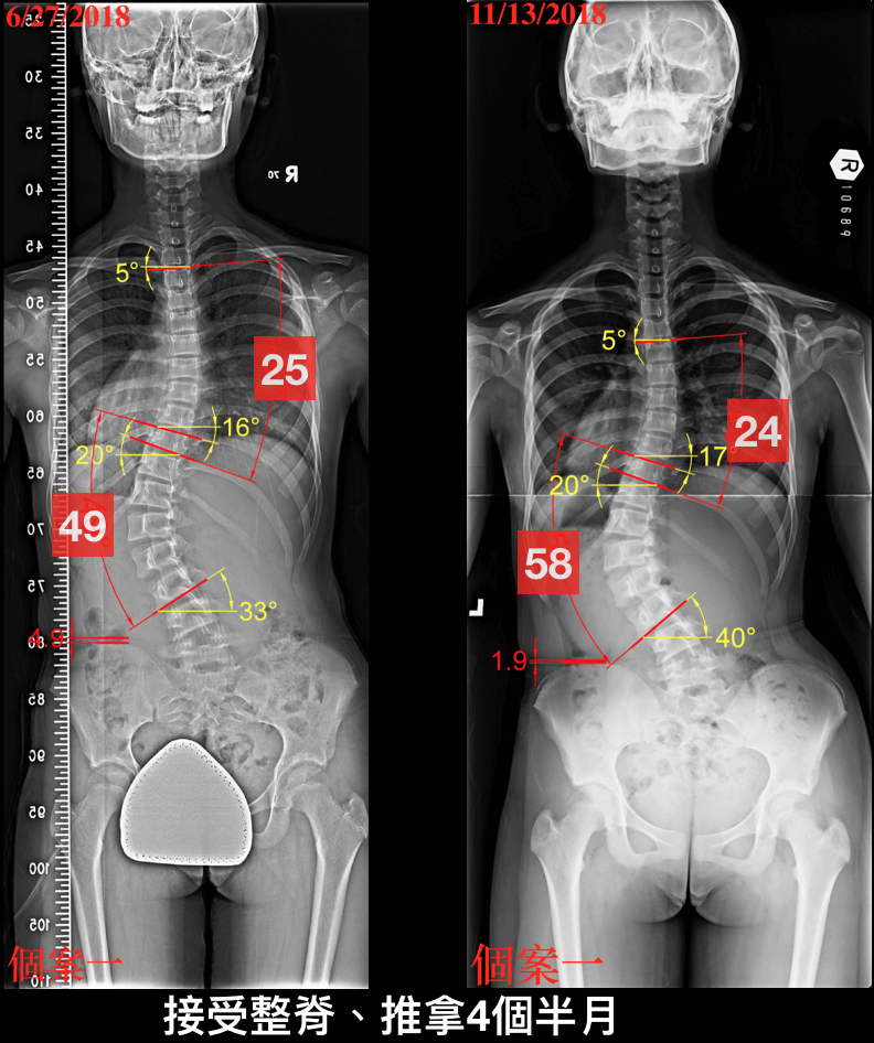 推拿治療前後側彎度數比較
