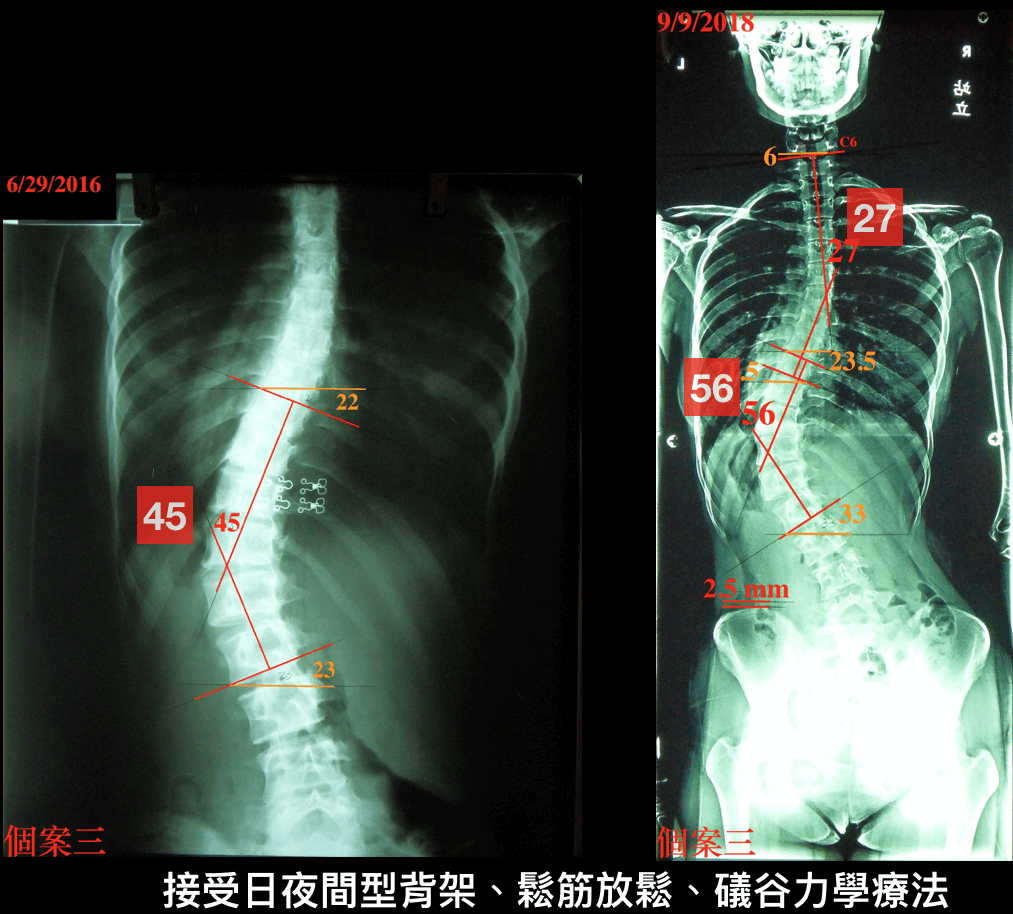 穿著背架胸腰側彎仍惡化案例