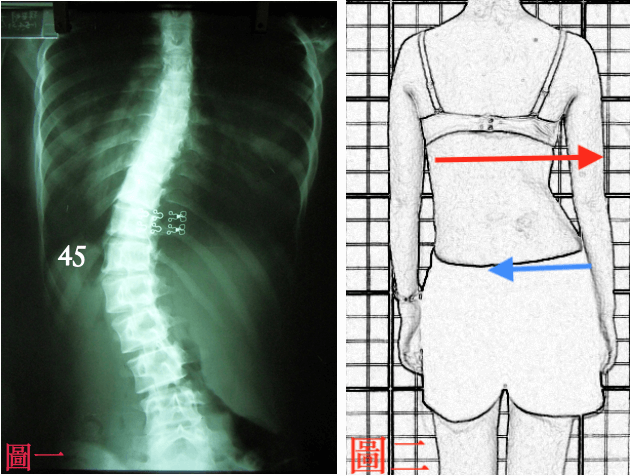 用力矯正側彎姿勢外觀