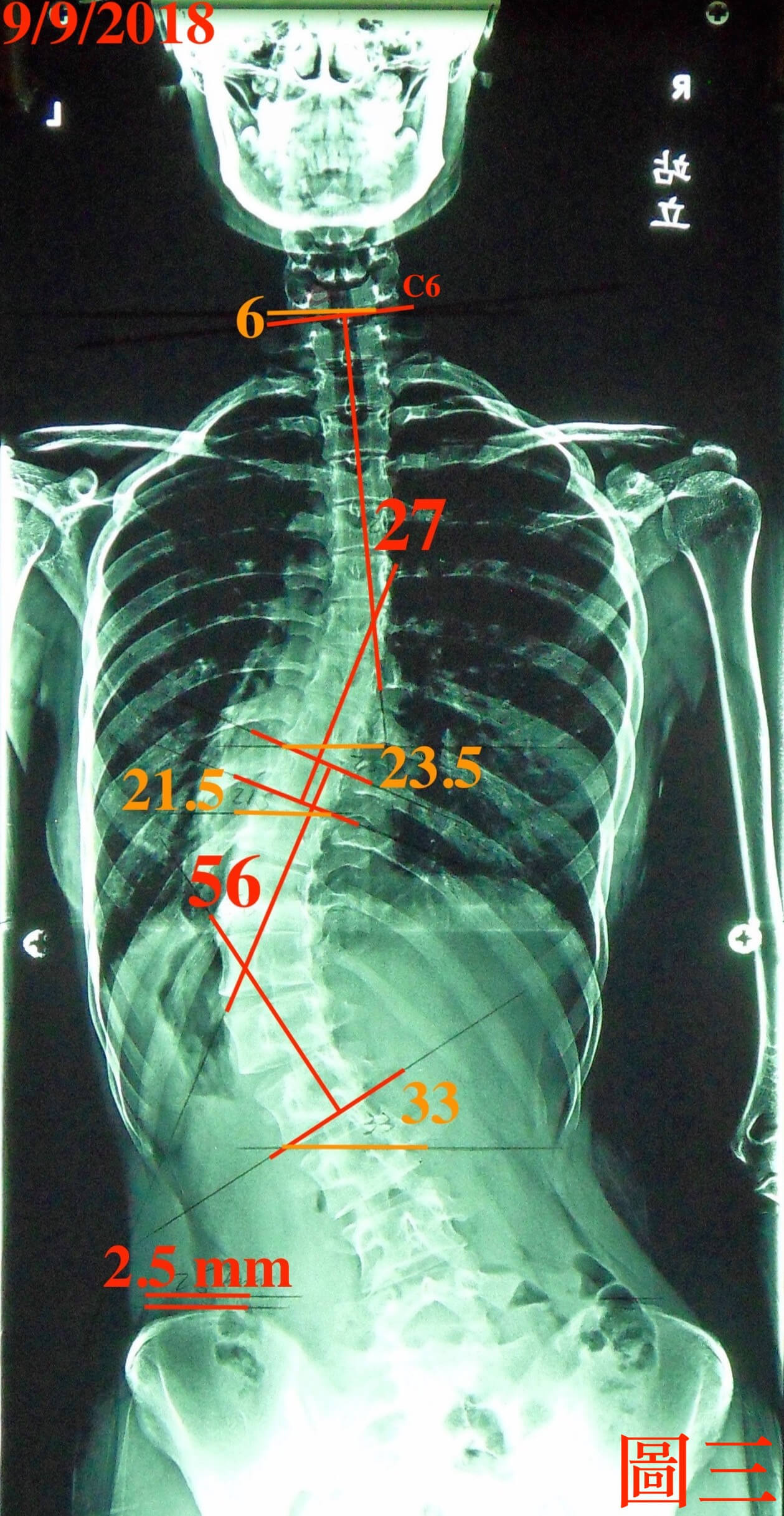 2年後腰椎側彎惡化11度