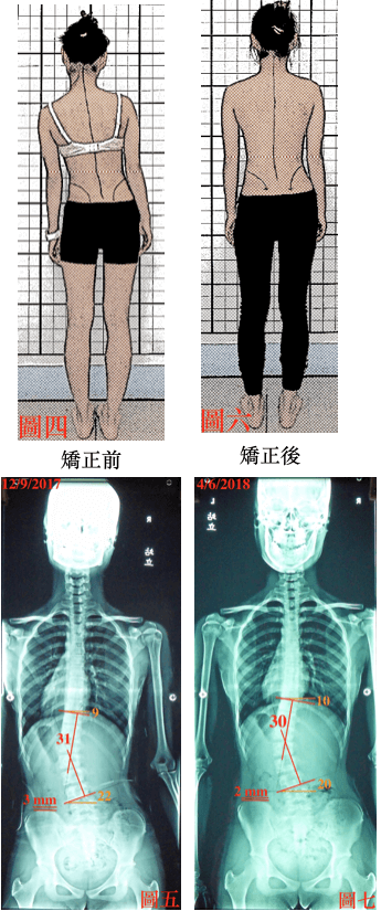 姿勢變好側彎度數未明顯好轉