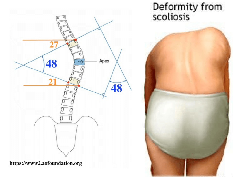 結構型脊椎側彎會伴隨椎體及肋骨旋轉