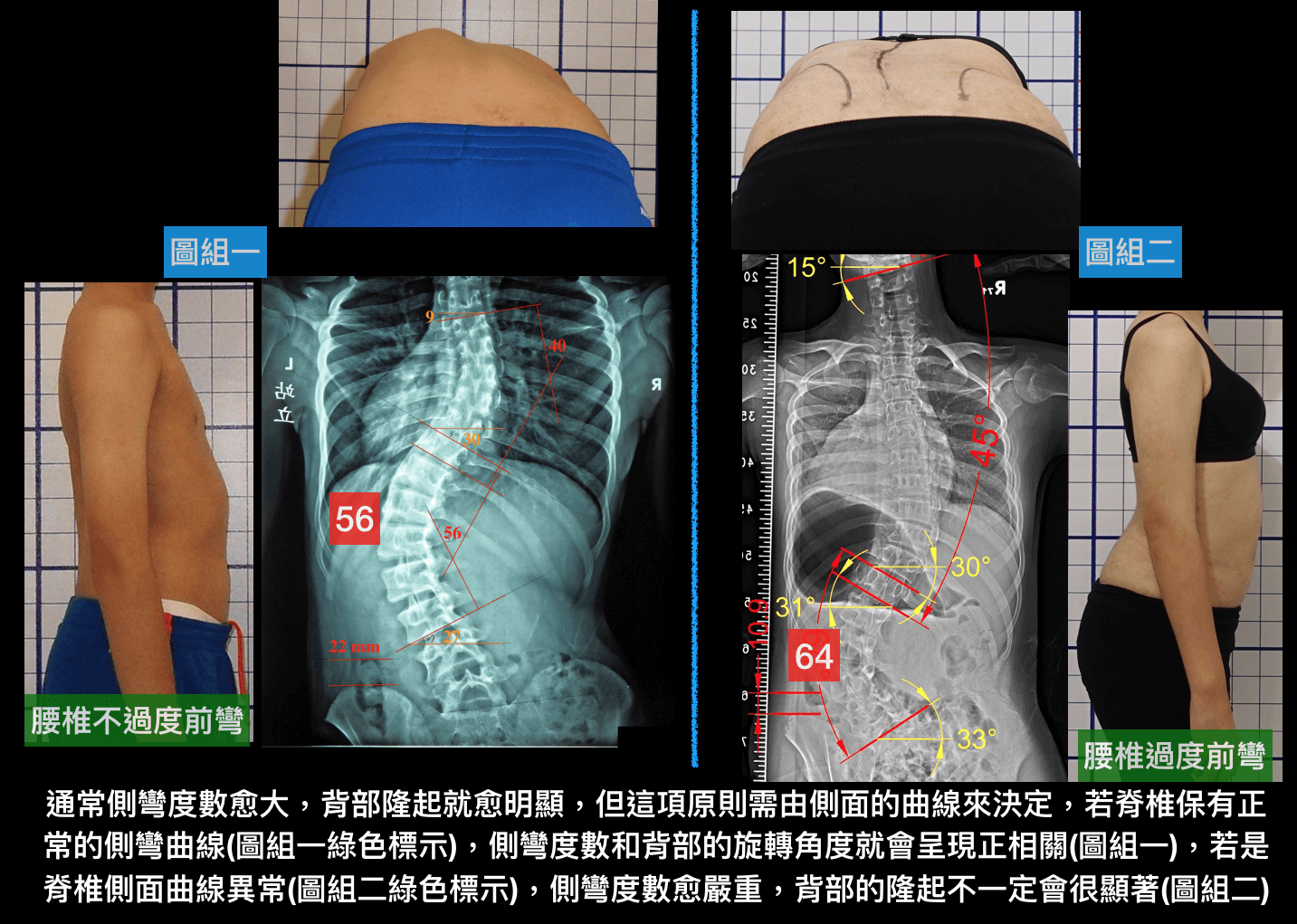 側彎度數與旋轉角度不一致