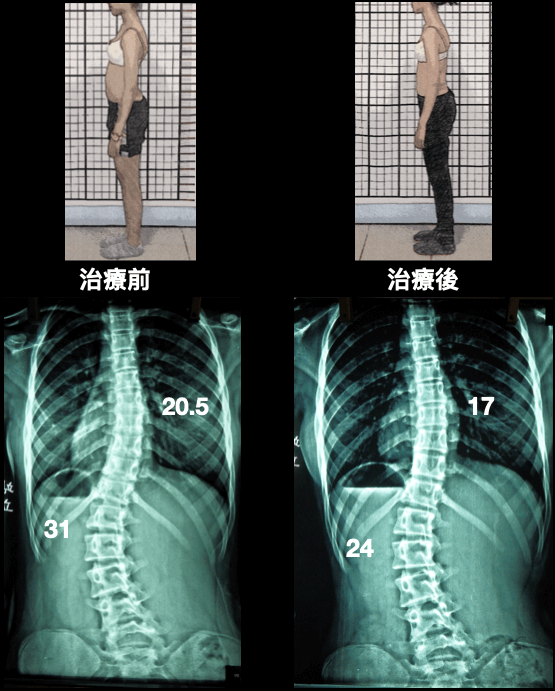 腰椎前彎幅度變小，雖然側彎度數進步可能會讓腰椎旋轉角度差異變大