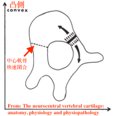 椎體兩側中心軟骨生長不對稱，造成椎體旋轉使側彎惡化